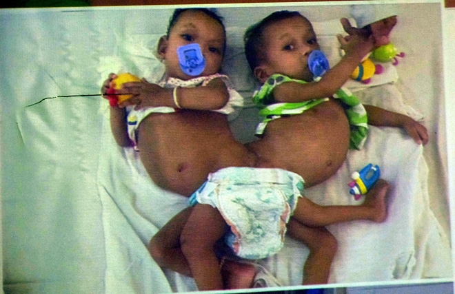 cặp sinh đôi dính liền vùng cùng cụt, cặp song sinh dính liền ở Việt Nam, phẫu thuật thành công cặp song sinh dính liền