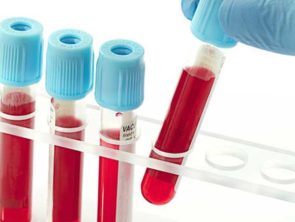 Triple Test là xét nghiệm sàng lọc, không phải xét nghiệm chẩn đoán